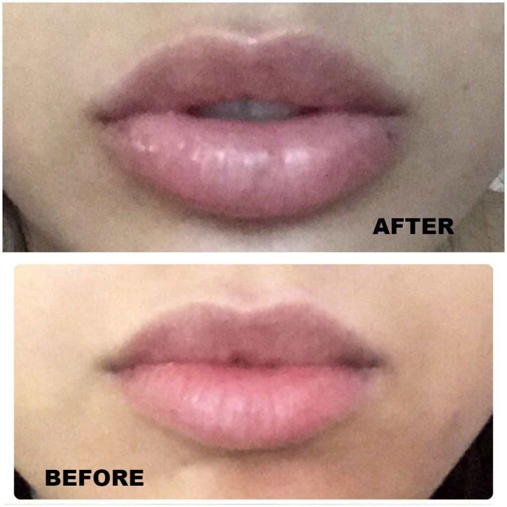 Lip Filler juvaderm restylane versa volbella silk