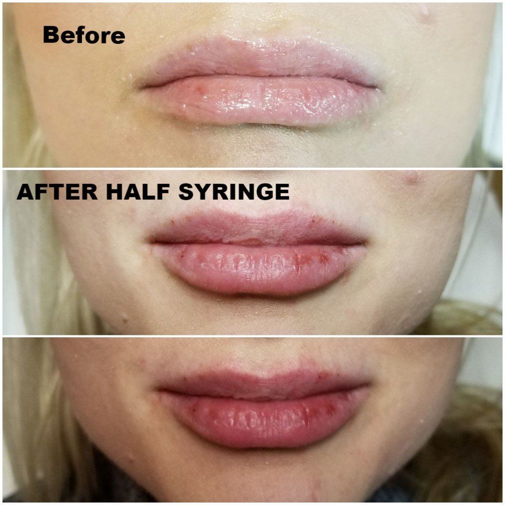 lip filler plump lips restylane juvaderm lipstick lip gloss