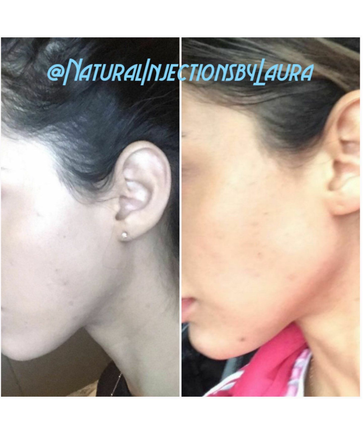 Jawline enhancement definition by ear filler injection radiesse jawline definition filler juvaderm restylante radiesse