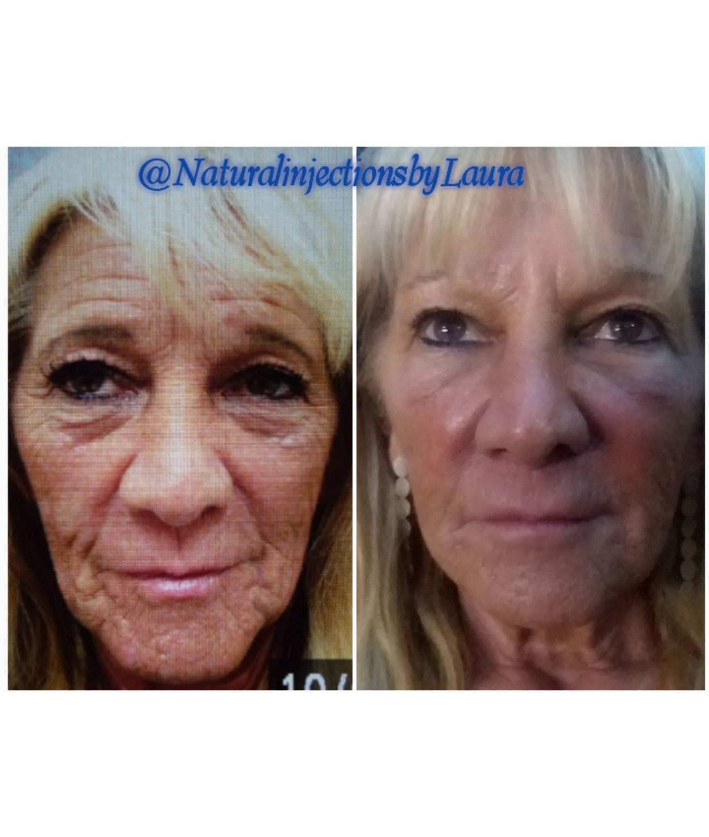 facelift wrinkles antiaging cosmetic surgery, plastic surgery, lip lines undereye circles fillers juvaderm restylane radiesse