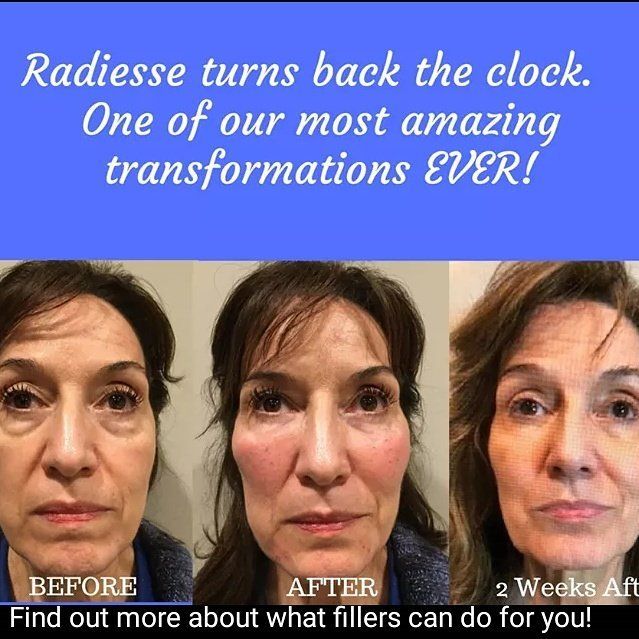 middle pic is with swelling immediately after Radiesse cheeks facelift undereye circles bags filler restylane
