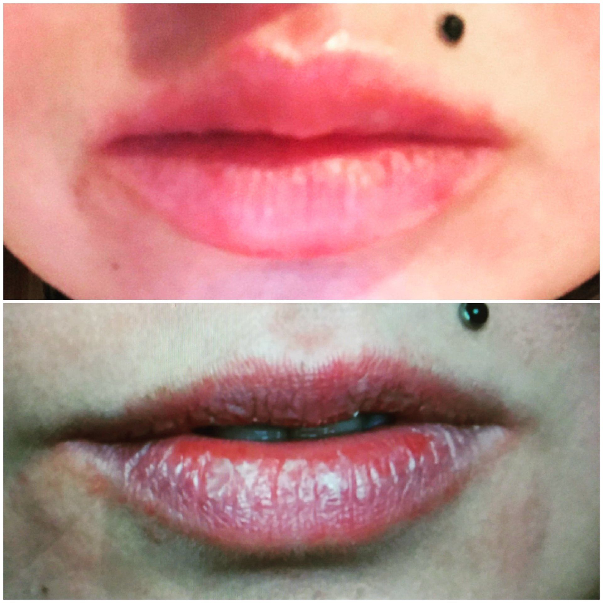lip filler restylane juvaderm, plump lips, lip gloss, lipstick