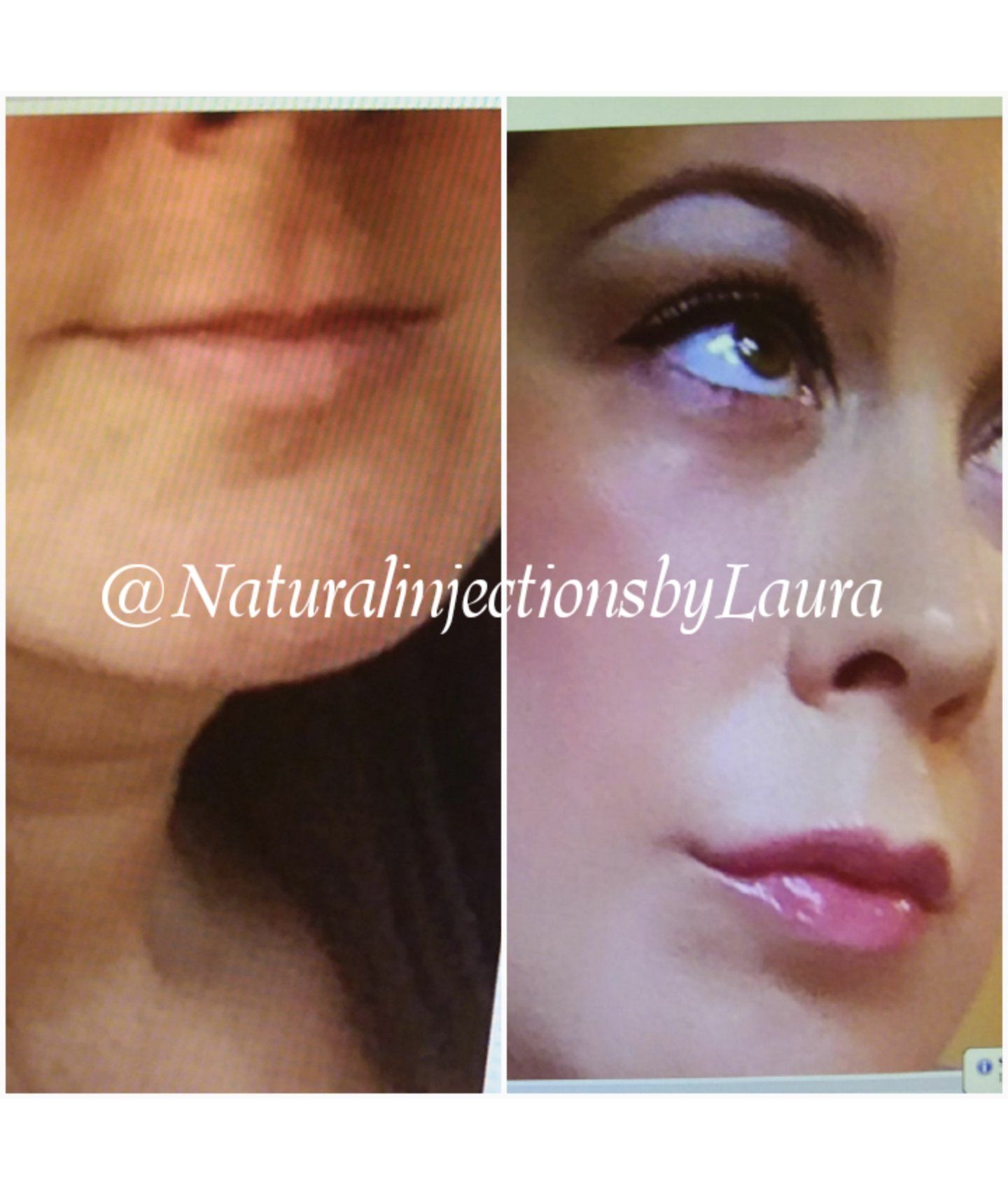 lip filler juvaderm restylane versa