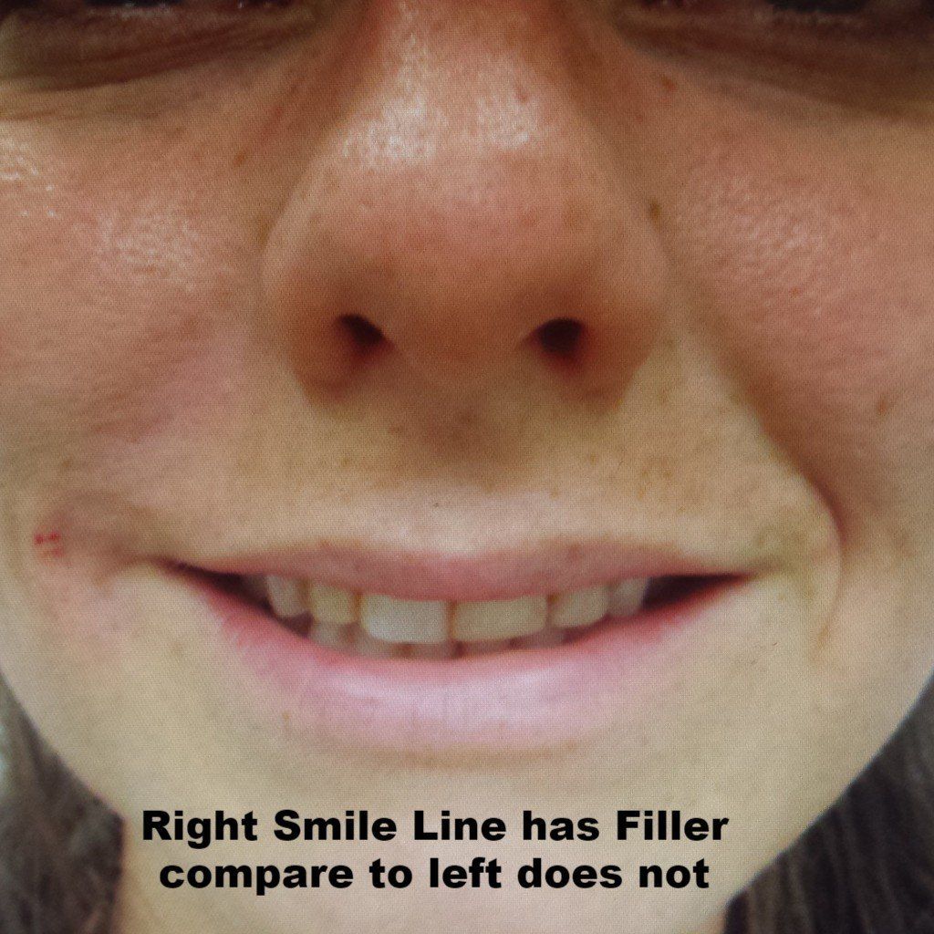 smile lines nasolabial folds filler juvaderm restylane radiesse wrinkles