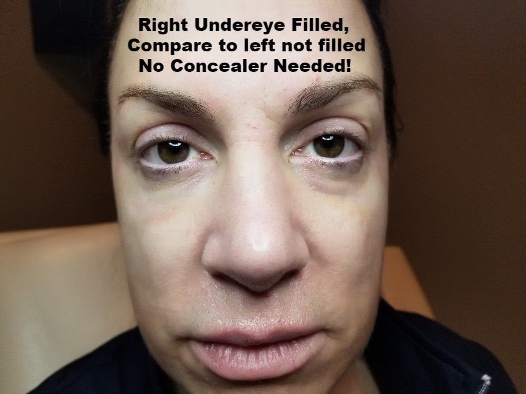 undereye dark circles filler juvaderm restylane radiesse smooth undereye wrinkles crows feet