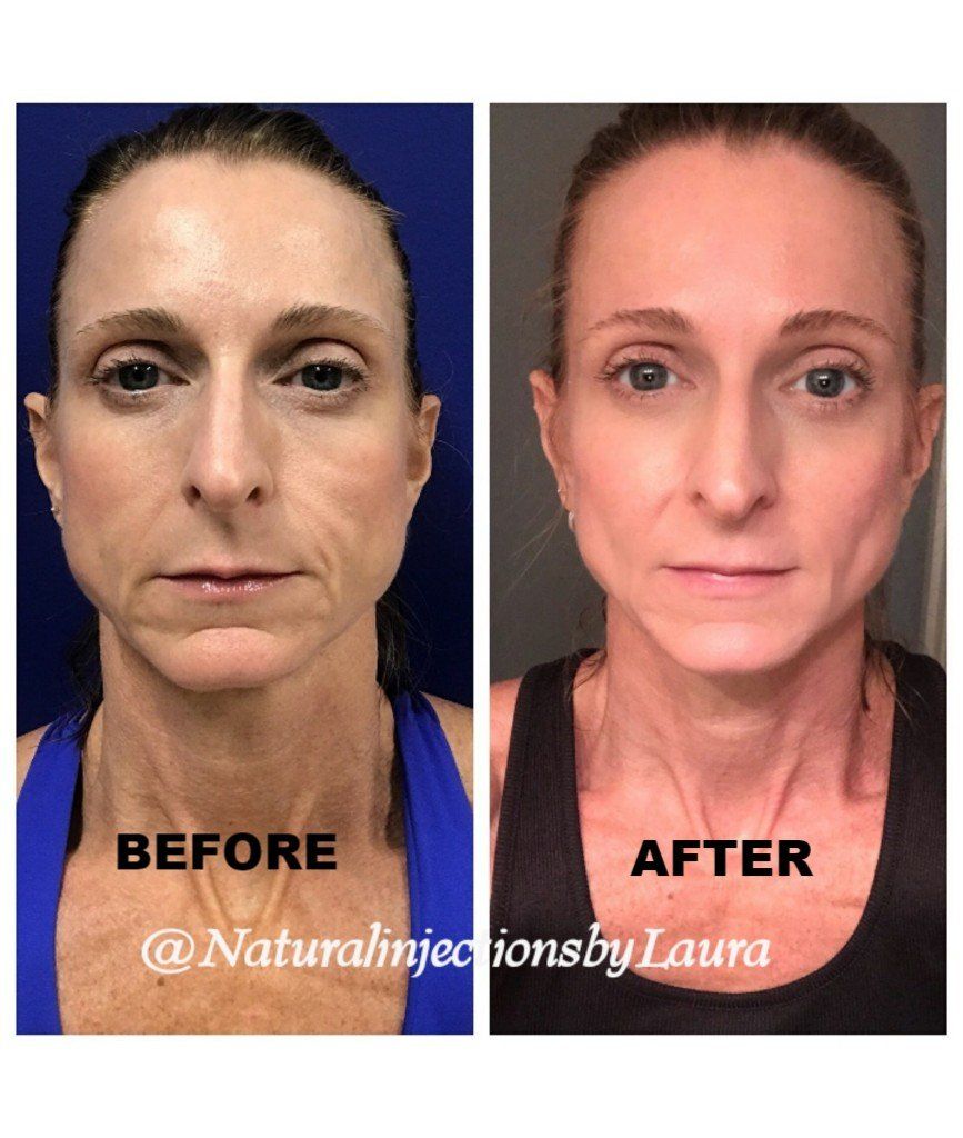 cheek filler facelift antiaging juvaderm restylane radiesse plastic surgery