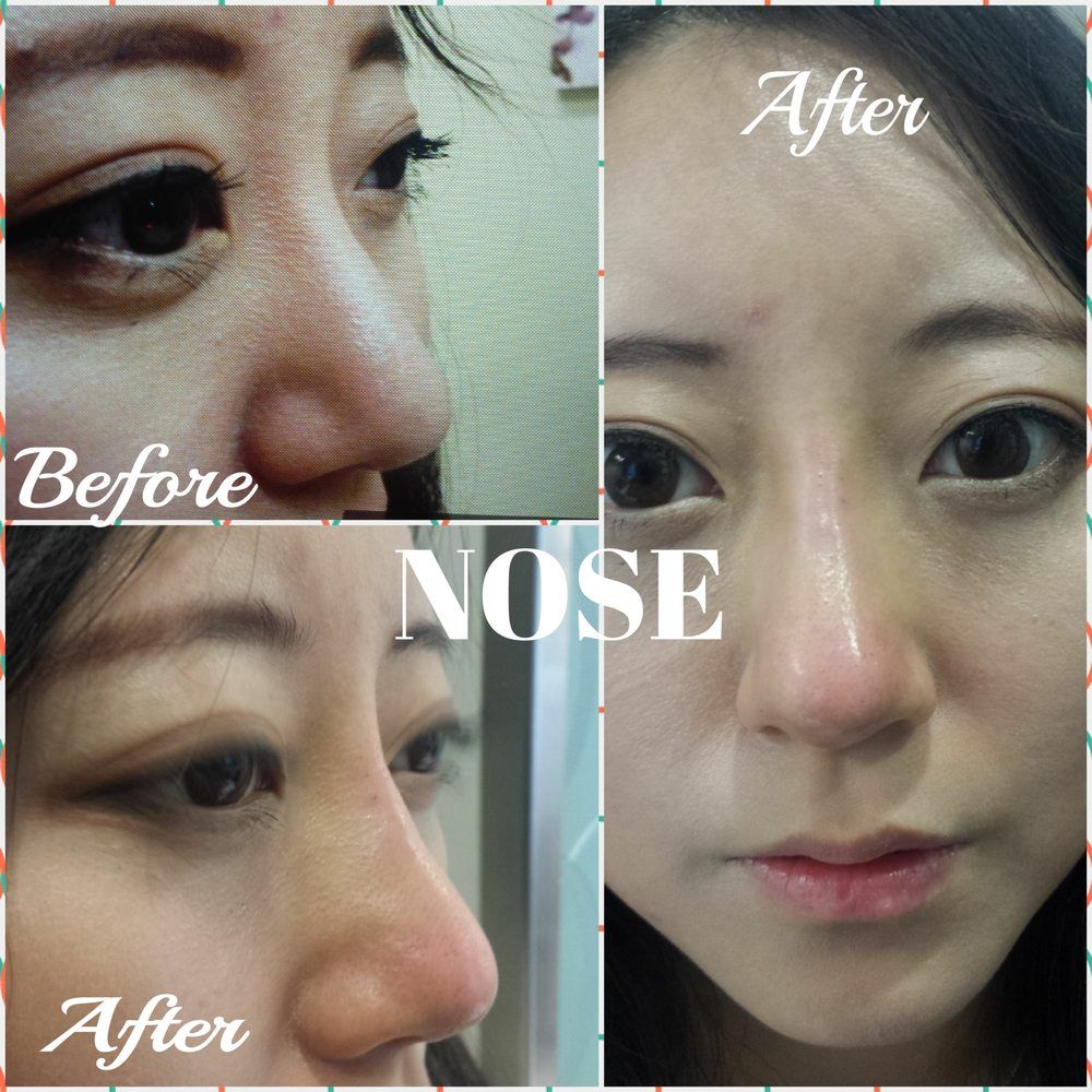 Nose Filler Pointier nose & bridge Juvaderm Radiesse Restylane