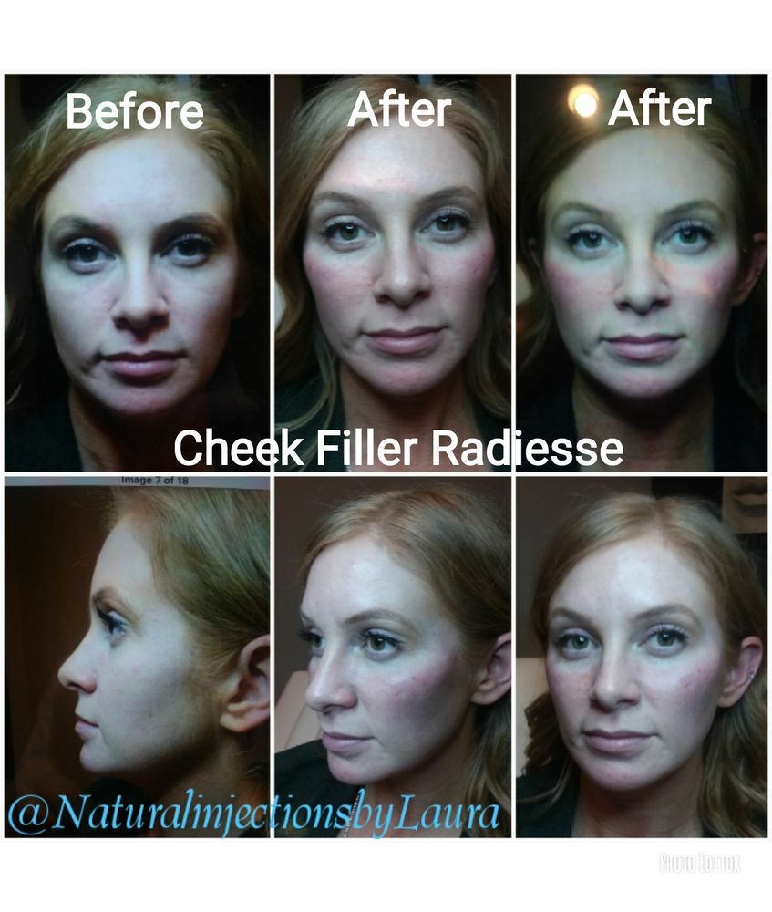 cheek contour dermal filler facelift radiesse juvaderm restylane