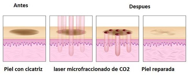 Cicatrices hipertróficas cicatrices hipertroficas genitales vaginales malaga