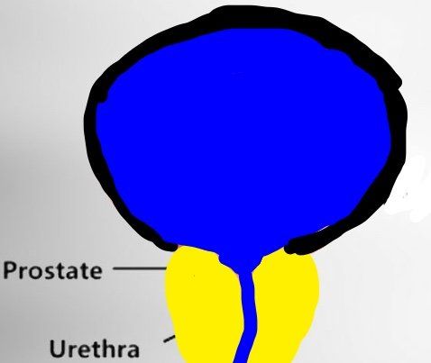 Enlarged prostate causing blockage