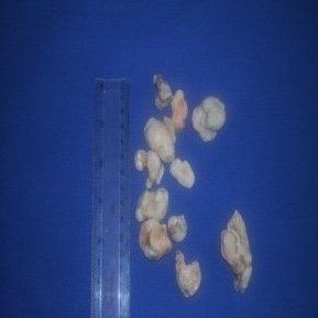 Large kidney stones Multiple large kidney stones removed by keyhole surgery