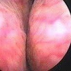 Enlarged prostate Enlarged prostate on Cystoscopy