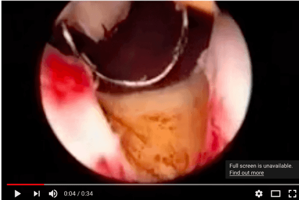 Transurethral resection of prostate (TURP) video
