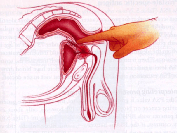 Rectal examination of prostate