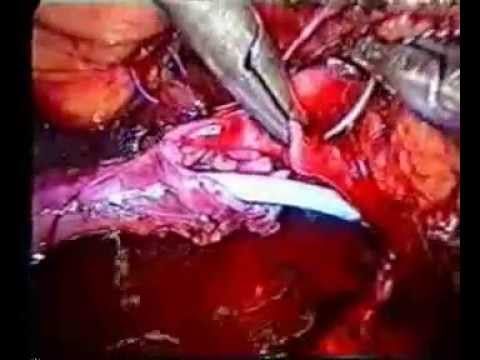 Laparoscopic Pyeloplasty(Keyhole Surgery to repair blocked kidney)