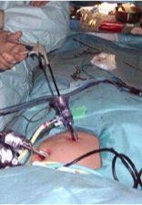 Laparoscopic Nephrectomy (Keyhole Surgery to remove the kidney)