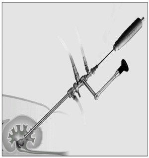 Keyhole surgery for stones or PCNL