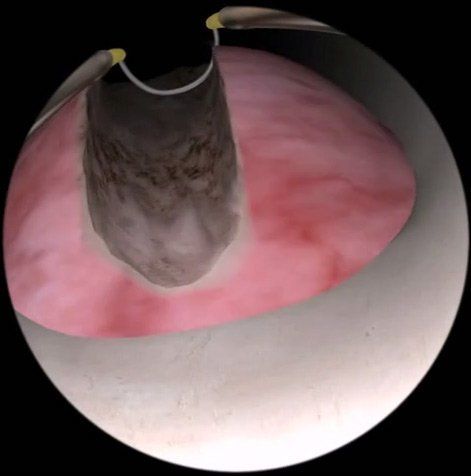 Surgical Treatment for prostate: TURP