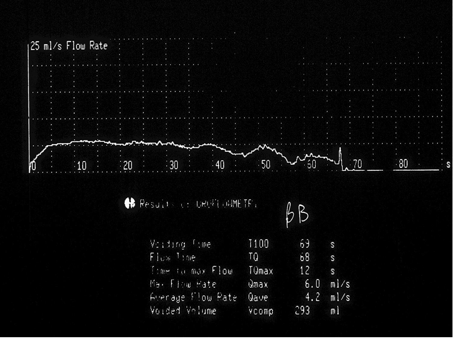 Abnormal Flow test Abnormal Flow test in Benign prostate enlargement