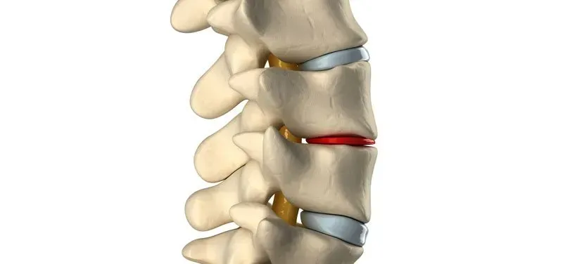 representacion en un modelo 3d de una columna con discipatía