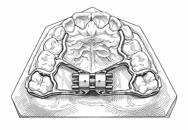 3D gedruckte KFO Apparaturen