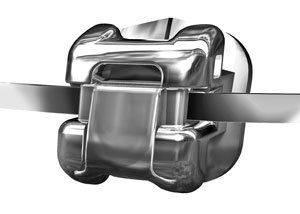 Bracket I feste Zahnspange