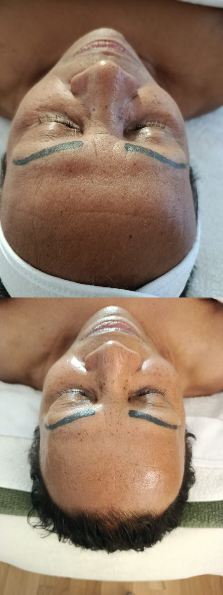 SFL vorher - nachher Sculptural face lifting