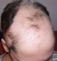 Alopezia areata (kreisrunder Haarausfall) Stand Oktober 2013 Alopezia areata (kreisrunder Haarausfall) Stand Oktober 2013