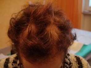 Nach 9 Mesohair Behandllungen - Stand November 2014 Nach 9 Mesohair Behandllungen - Stand November 2014