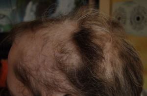 Nach 6 Mesohair-Behandlungen - Stand August 2014 Nach 6 Mesohair-Behandlungen - Stand August 2014