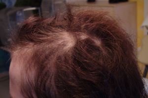 Nach 9 Mesohair-Behandllungen - Stand November 2014 Nach 9 Mesohair-Behandllungen - Stand November 2014