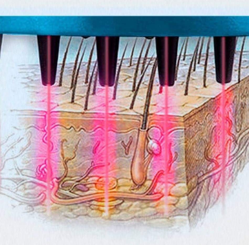 Demo Phototherapie (Lasertherapie)