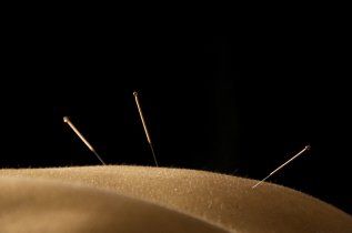 Akupunktur Akupunktur in Winnenden