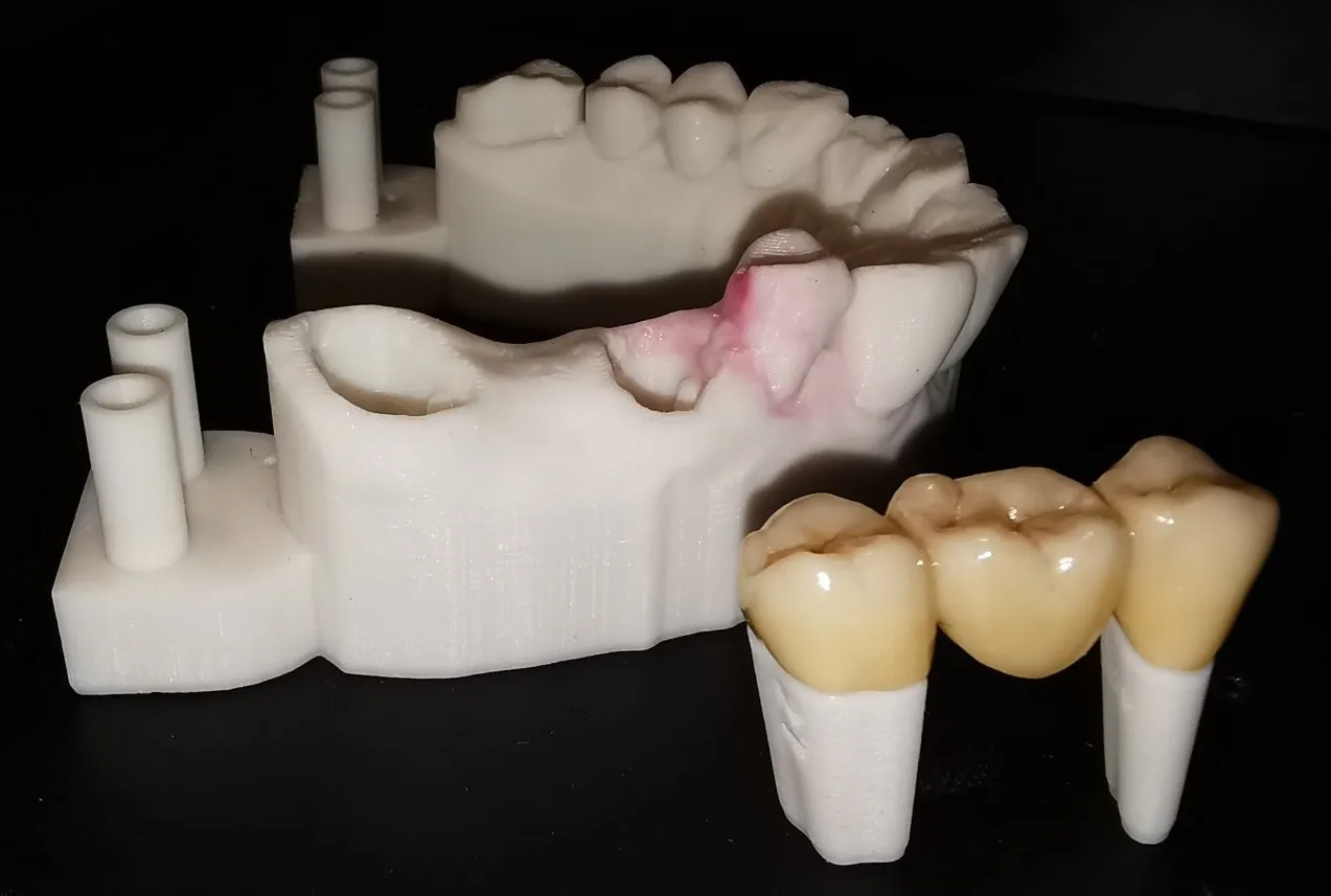 CAD/CAM,Vollzirkon, Interoralscann,