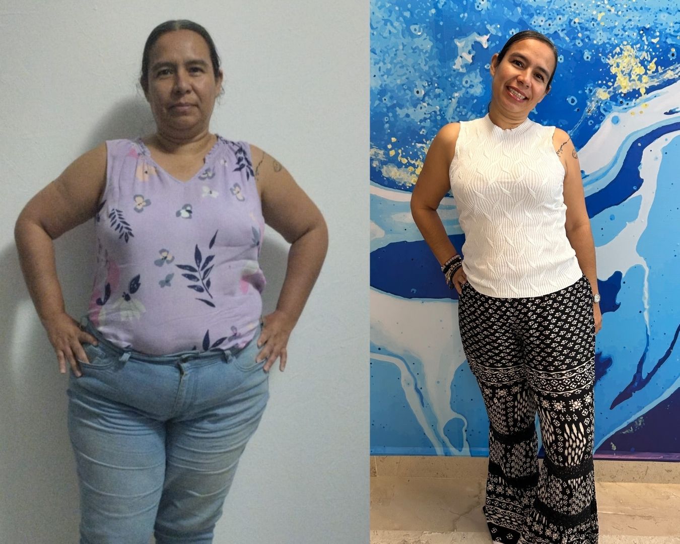 Costos Cirugía Bariátrica en Ciudad de México