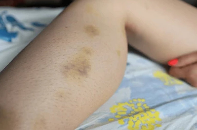 ? Moretones (equimosis) después de la cirugía bariátrica: causas, frecuencia y qué hacer