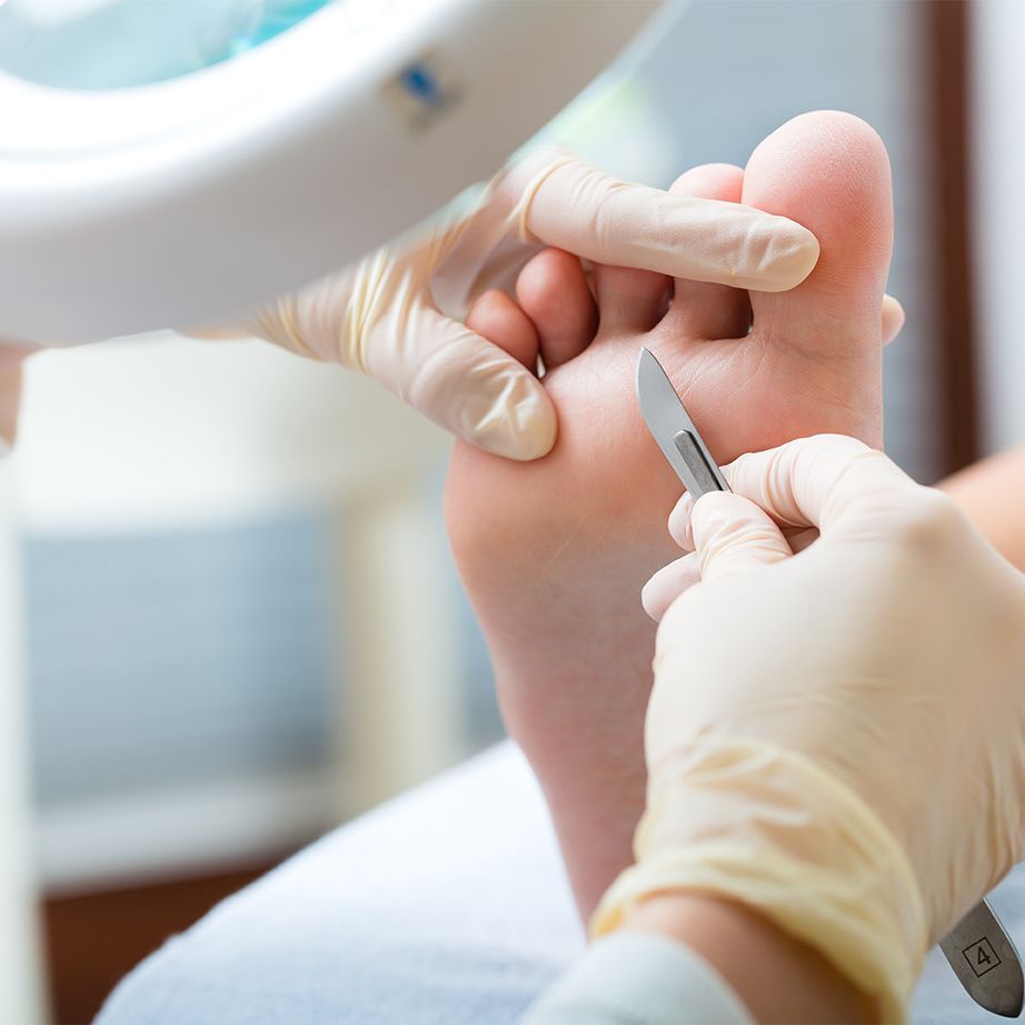 Hornhaut und Schwielen an den Fußsohlen durch medizinische Fußpflege entfernen lassen