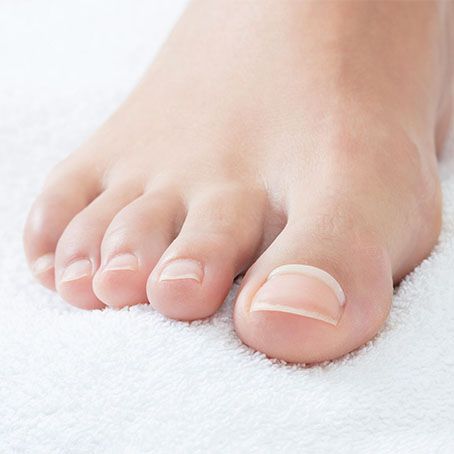 Die Onyfix Klebespange bietet eine schmerzfreie Lösung zur Behandlung eingewachsener Nägel.