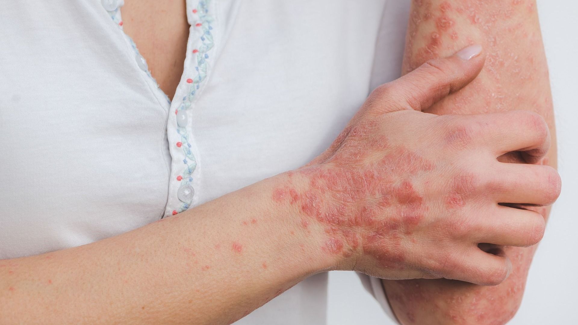 Psio troubles fonctionnels, psoriasis