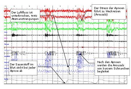 Das obstruktive Schlafapnoesyndrom Das obstruktive Schlafapnoesyndrom