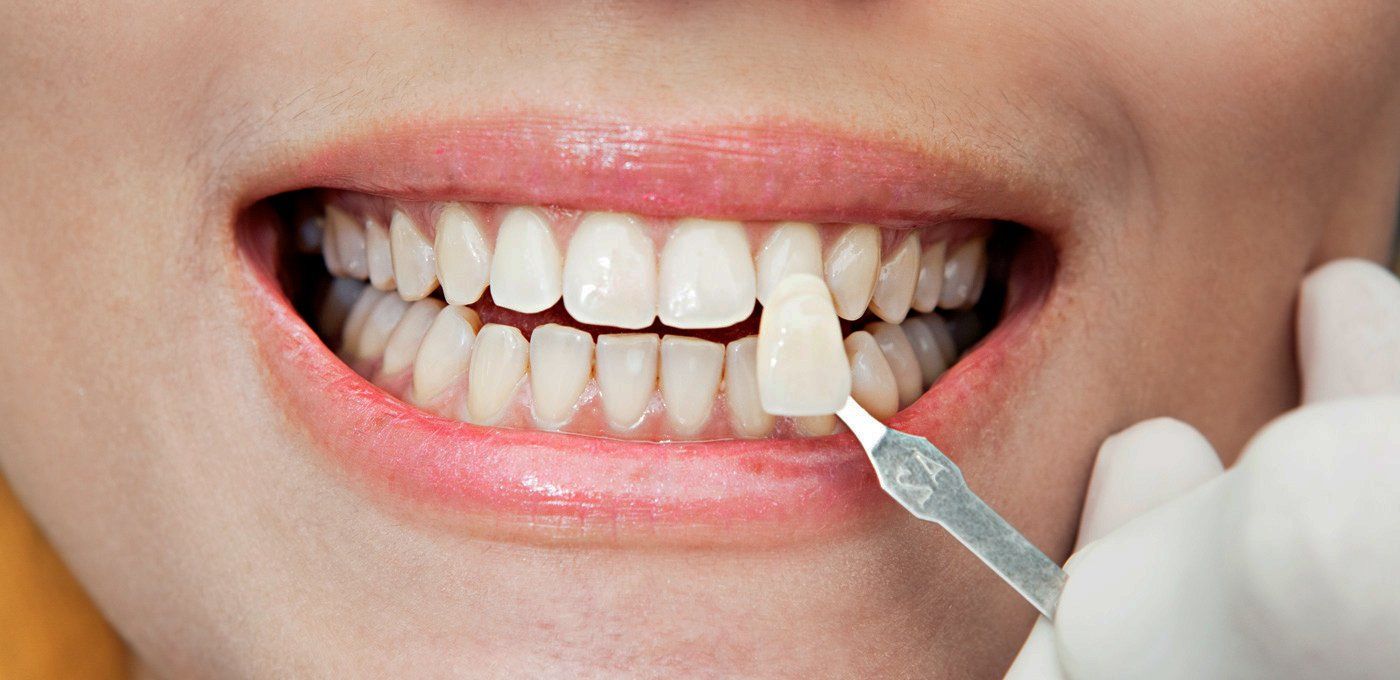 Carillas dentales en Valencia