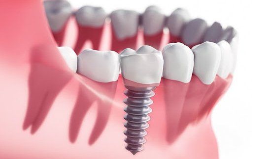 Implantes dentales Implantes dentales