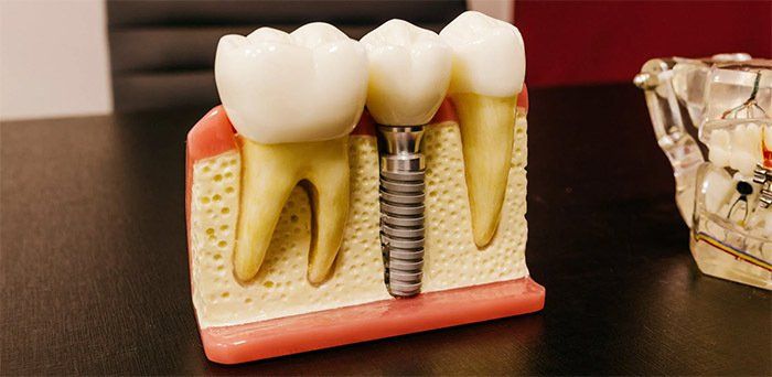 ¿Cuánto cuesta un implante dental en Valencia?