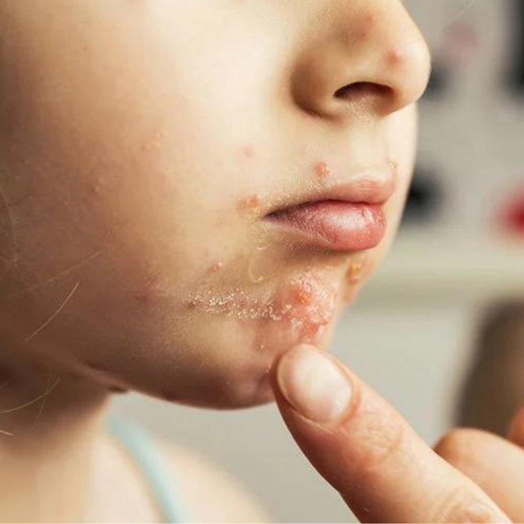 impetigo on little boy