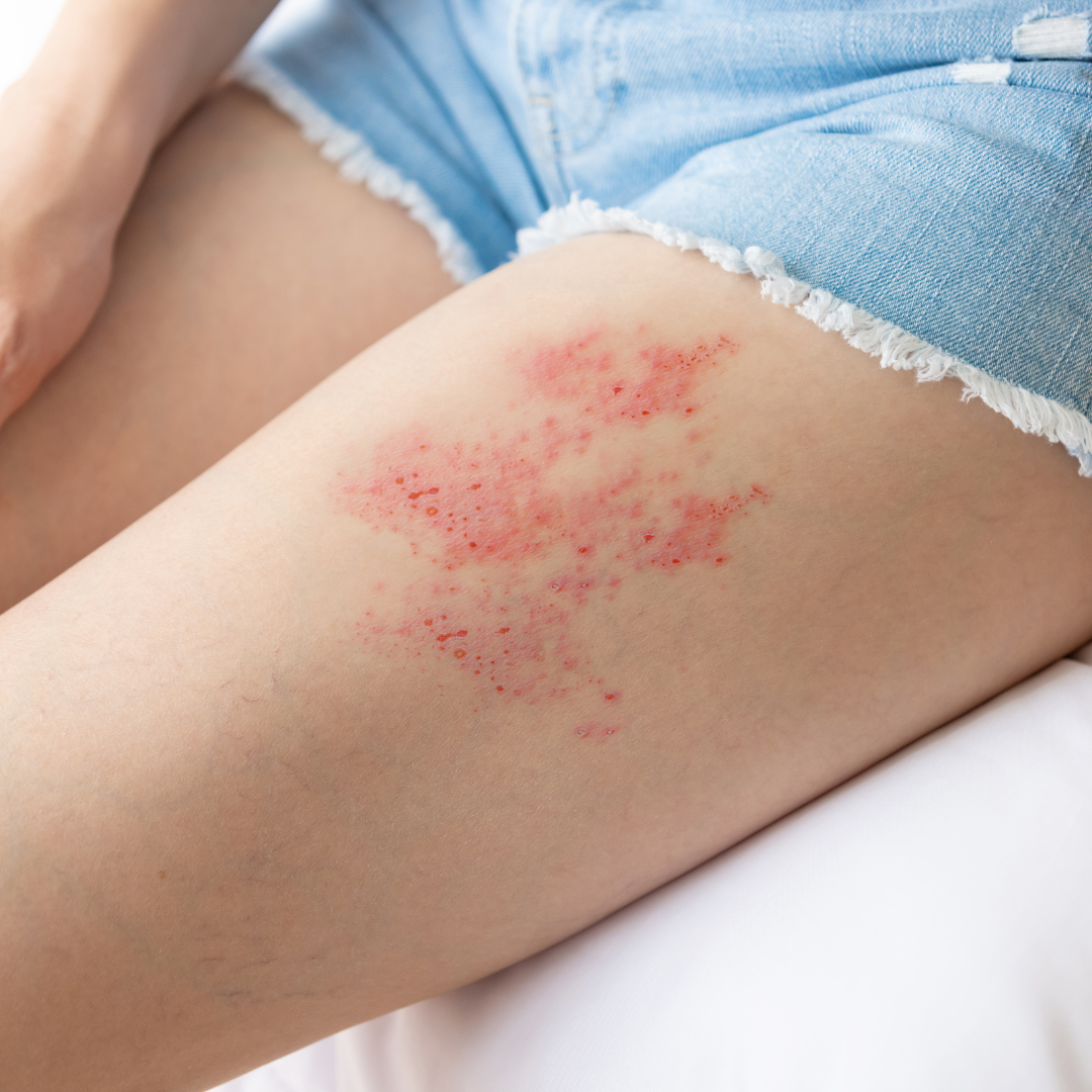 shingles on leg