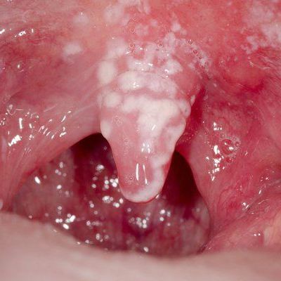 tonsilitis