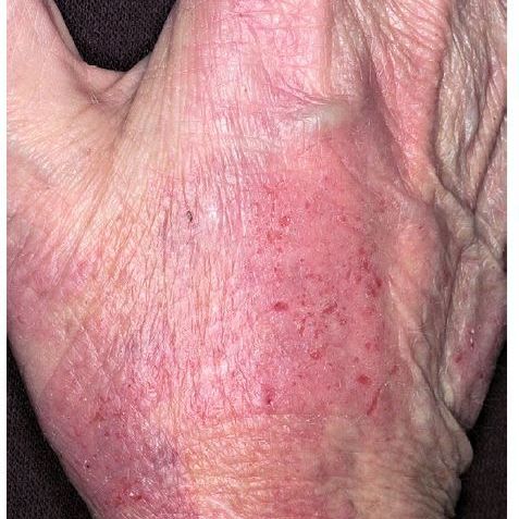 rash on hand