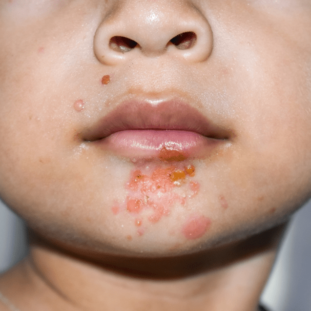 boy with impetigo