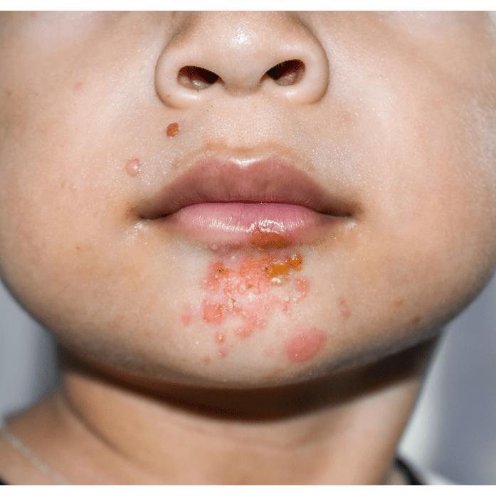impetigo face