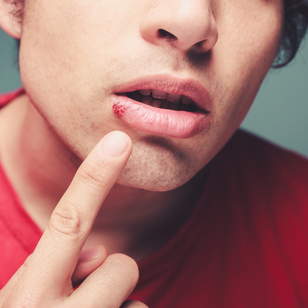man with cold sore
